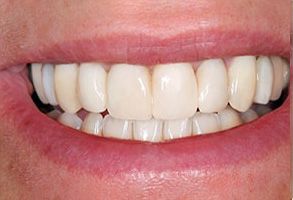 Smile Care Dental Group | Veneers, Periodontal Treatment and Fluoride Treatment