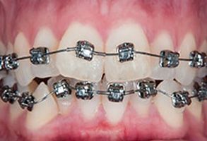 Smile Care Dental Group | Dental Bridges, Ceramic Crowns and Dentures
