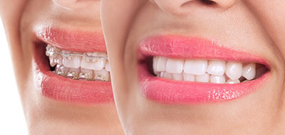 Smile Care Dental Group | Ceramic Crowns, Braces and Implant Dentistry