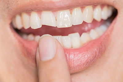 Smile Care Dental Group | Dental Fillings, Dental Bridges and Veneers